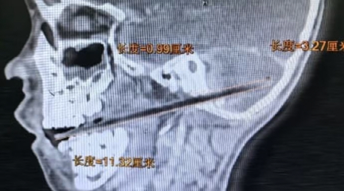 사탕 먹다가 넘어진 6세, 11cm 막대기가 입 뚫고 뇌에 박혀