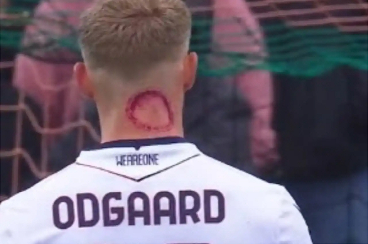 "저 선수 좀비한테 물렸나 봐" 기괴한 부상에 팬들 발칵...당사자 해명…