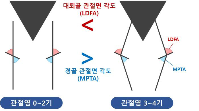 서울대병원 연구진, AI로 무릎 정렬에 따른 관절염 위험 차이 규명