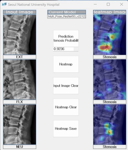 "MRI 촬영 없이 X선 사진으로 요추협착증 진단 AI 개발"