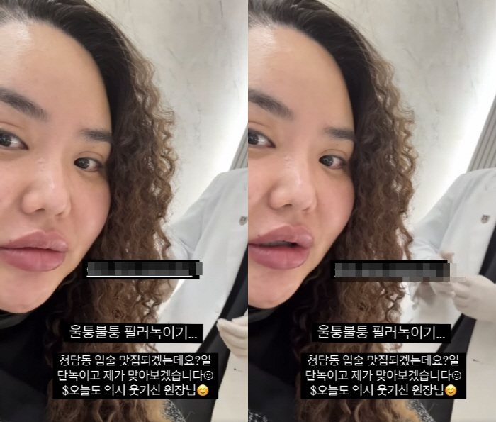 '홍진영 언니' 홍선영, 입술 필러 맞아 울퉁불퉁해졌는데.."녹이고 또 …