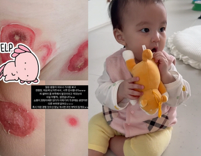 이지훈, 면역결핍 투병 고백 "10년째 고통, 딸도 피부병 겪어"