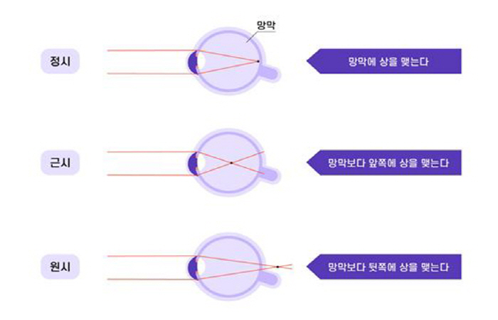 "스마일프로, '원시 교정' 시력 회복 성공적"…온누리 안과 임상 결과 발표