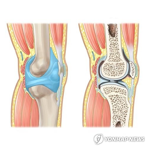 충남 천안의료원 인공관절치환술 6천회 돌파