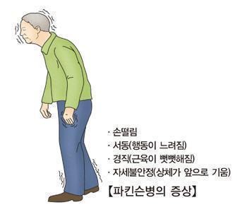 日교토대 "유도만능줄기세포로 파킨슨 환자 치료…증상 개선"