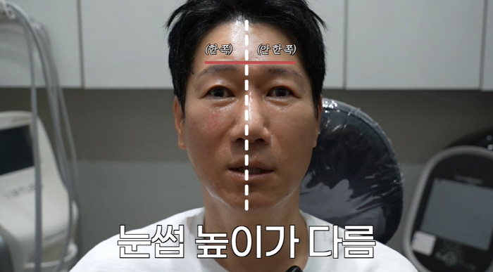 '59살' 지석진, 리프팅 시술 후 확 달라졌다 "입꼬리까지 올라가"