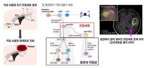 악성 뇌종양 '교모세포종' 되기 직전 단계 암세포 찾았다