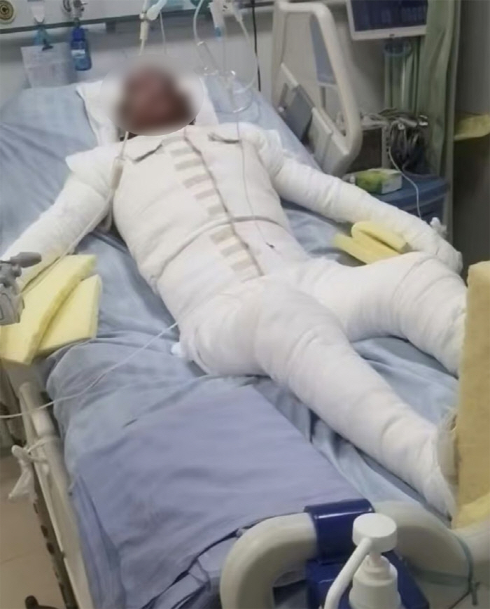 자전거 배터리 폭발로 신체 90% 화상 20대 남성 "친구 용서 못 해"