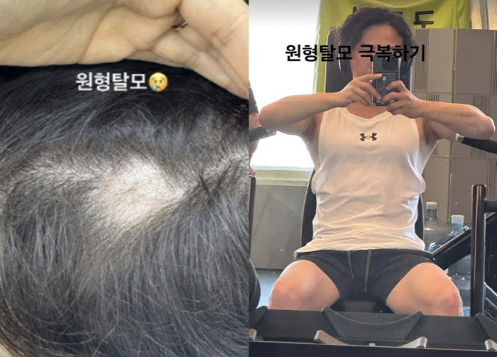 박성광, '암투병 삭발' ♥이솔이 맘고생 심했나..원형탈모 고난 "극복하…
