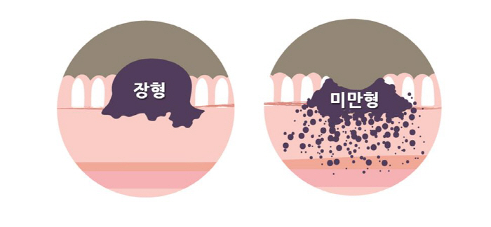 암검진 사각지대 '젊은 미만형 위암', 조기 진단 가능성 열렸다