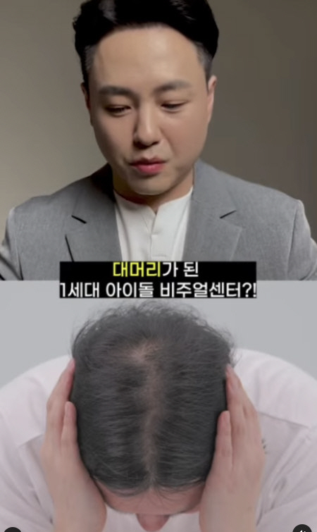 노유민, 커피로 건물 세우더니…모발이식으로 탈모 탈출 "정수리 고민 해결"
