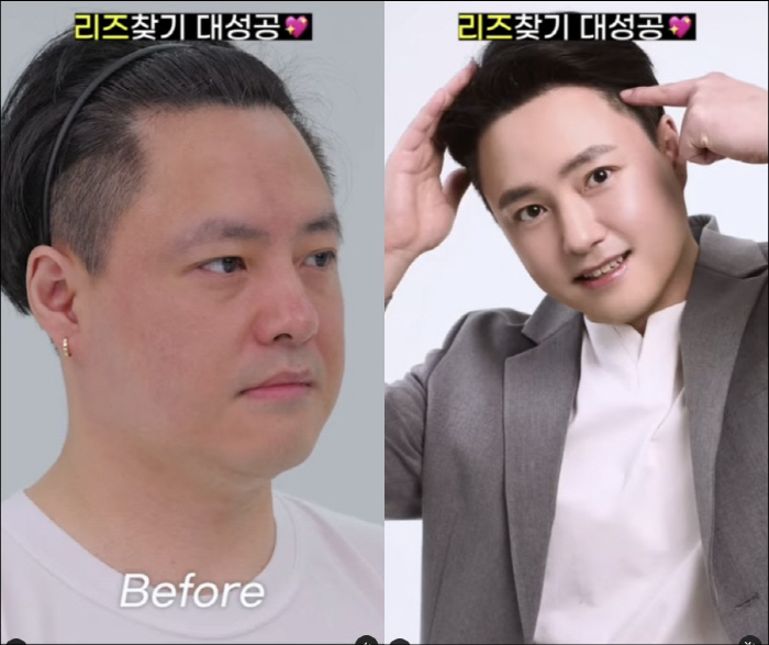 노유민, 커피로 건물 세우더니…모발이식으로 탈모 탈출 "정수리 고민 해결…