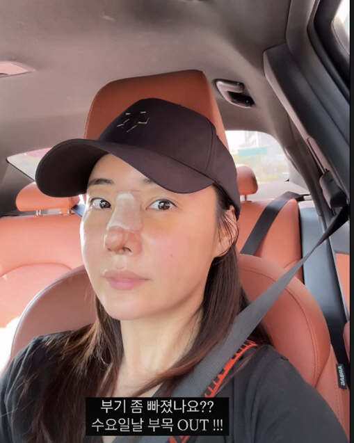 '조혜련 올케' 박혜민, 코 재수술 부기 고생 "2일 후 부목 제거"