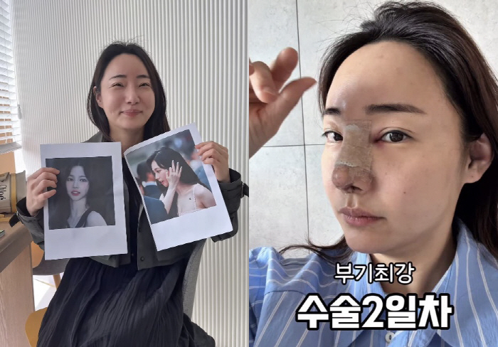 '조혜련 올케' 박혜민, 코 재수술 부기 고생 "2일 후 부목 제거"