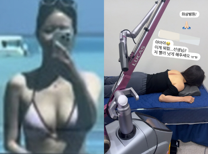 결혼 앞둔 박하나, 심각한 화상 상처..침대에 엎드려 “빨리 낫길” 고통 호소