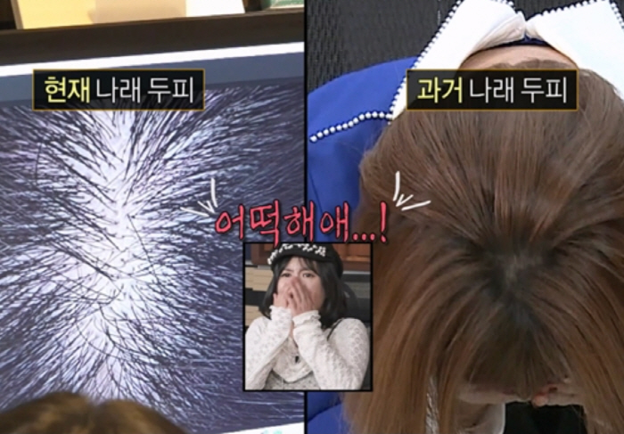 '탈모 고백' 박나래, 충격적인 정수리 상태..노화+남성호르몬 원인('나혼산')