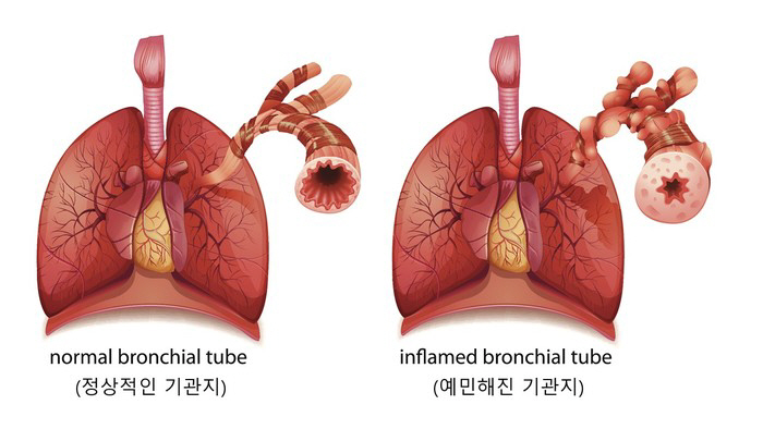 [소아 천식 Q&A] 급성 천식 발작일 땐 생명 위협…약 먹으면 키 성장…