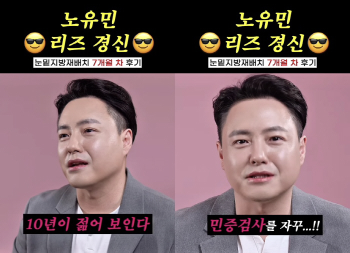 노유민, 커피 팔아 건물주 되더니..눈밑지방+탈모 시술로 리즈 갱신