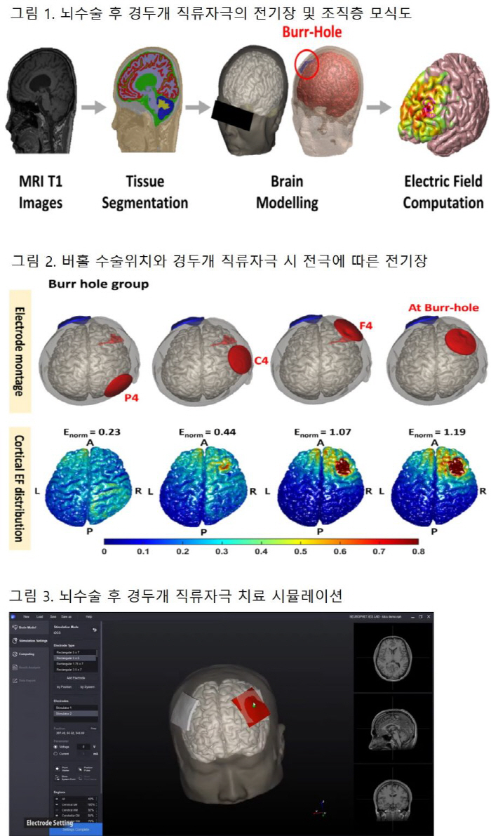 "전자약 '경두개직류자극', 두개골 손상 환자도 치료 가능"