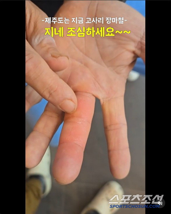 김병만, '거대 지네'에 물렀다...퉁퉁 부은 손+선명한 이빨자국