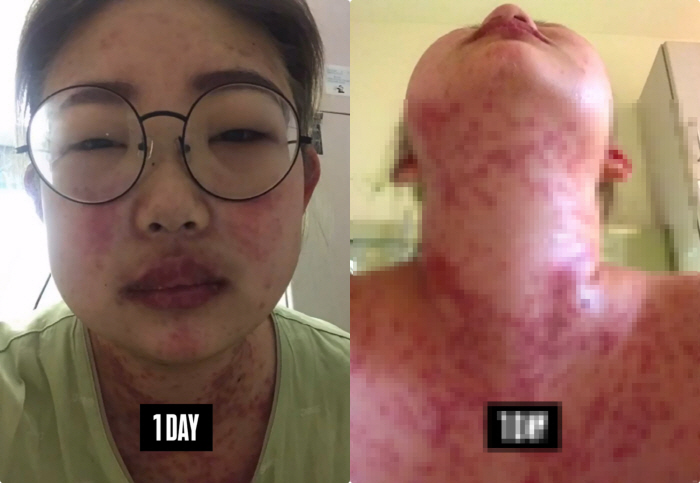 '55kg 감량' 최준희, 심각했던 루푸스 약물 부작용 "먹방 유튜버처럼…