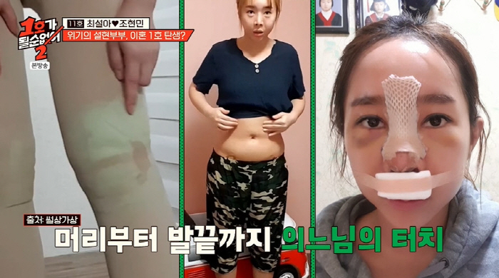 최설아 "눈·코 성형, 허벅지·아랫배 지방흡입도...난 부작용 아이콘" …