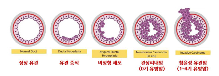 [유방암 Q&A] 30세 이상 매달 자가검진해야…발생률 증가 원인 '3가…