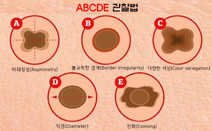 주근깨 반점인 줄 알았는데 '피부암'…'흑색종' 온몸에 전이