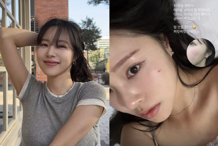 '박성광♥' 이솔이, 차 문 열다 '쾅!'...예쁜 얼굴에 상처 어쩌나 