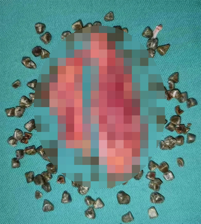 과도한 다이어트·고지방 식사, 몸속에 '돌' 생긴다