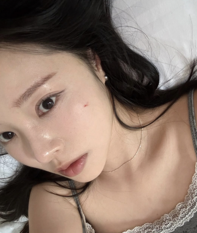 '박성광♥' 이솔이, 암 투병 후 '얼굴 부상'에 또 비상…"가족들 다 …