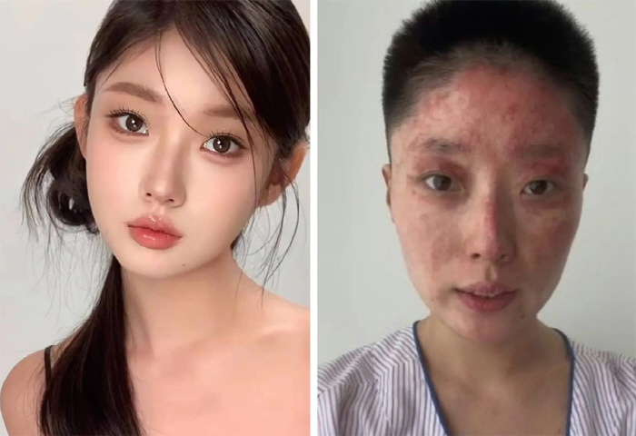 아버지 담뱃불로 가스 폭발…화상 공개한 미녀 인플루언서 "쇼가 아니야"