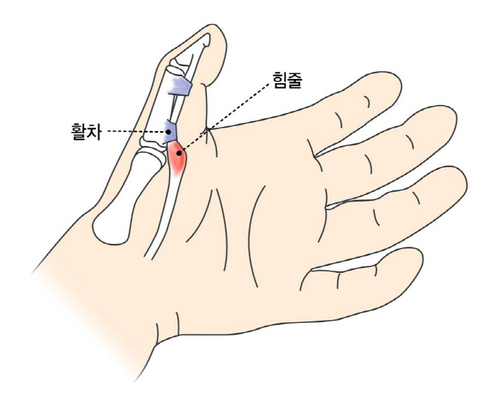 손가락에서 '딸깍' 방아쇠 손가락, 50대 여성 주의…예방과 치료는?