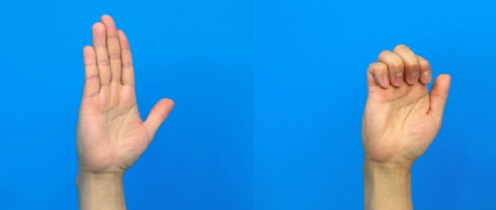 손가락에서 '딸깍' 방아쇠 손가락, 50대 여성 주의…예방과 치료는?