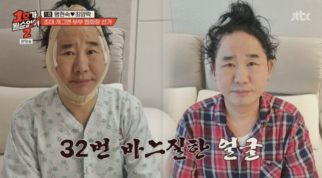 ‘페이스오프급 성형’ 최양락, 눈·거상·32바늘 꿰맸다? 이봉원 폭로에 …