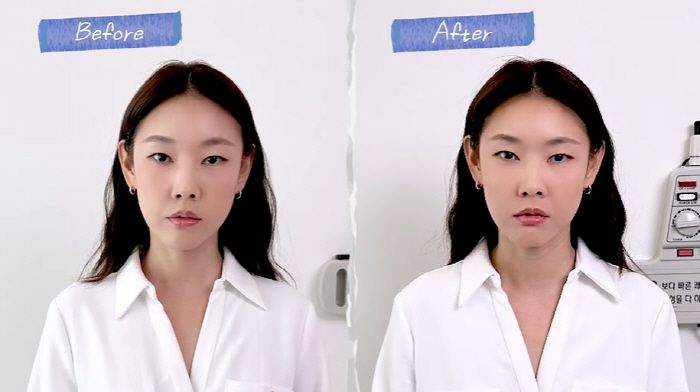 한혜진, 침 성형 후 확 달라진 얼굴..."양볼 두께 두 배 차이 났었다…