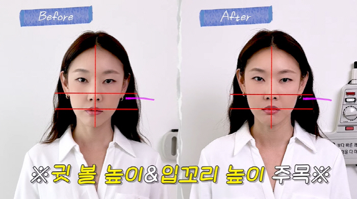 한혜진, 침 성형 후 확 달라진 얼굴...