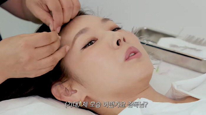 한혜진, 침 성형 후 확 달라진 얼굴..."양볼 두께 두 배 차이 났었다…