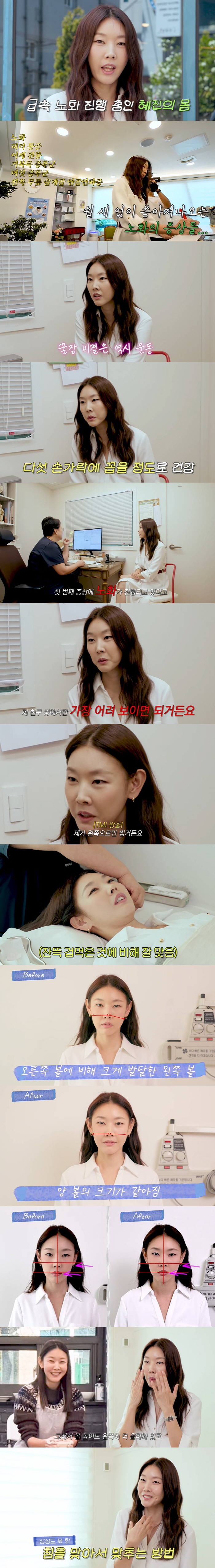 한혜진, 침 성형 후 확 달라진 얼굴..."양볼 두께 두 배 차이 났었다…