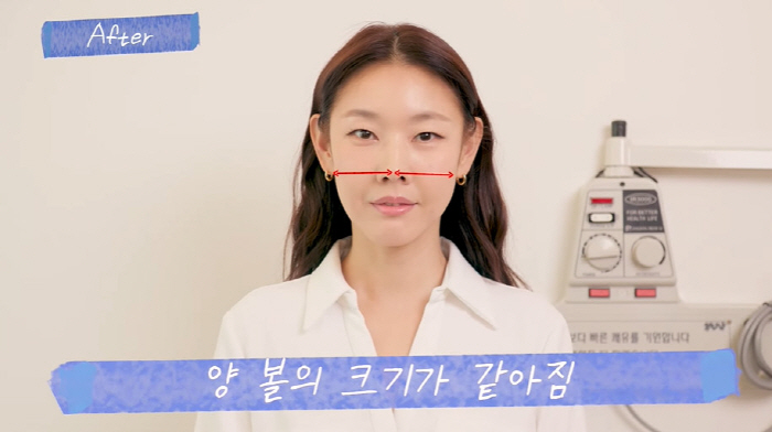 한혜진, 침 성형 후 확 달라진 얼굴..."양볼 두께 두 배 차이 났었다…