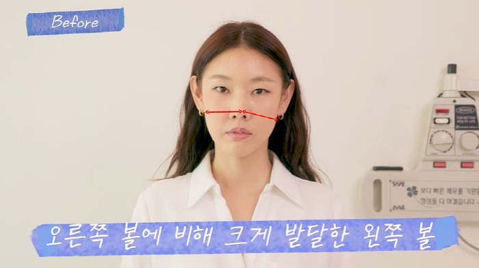 한혜진, 침 성형 후 확 달라진 얼굴..."양볼 두께 두 배 차이 났었다…