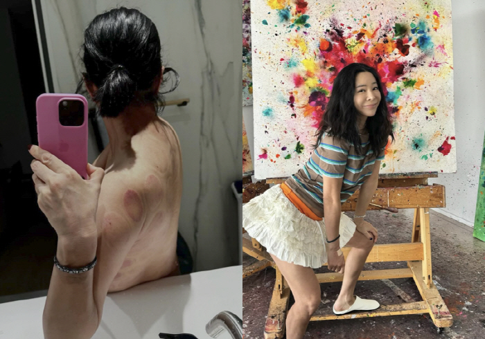 이혜영, 화가 쉽지 않네...등 전체가 부황 자국 
