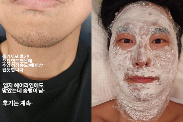김시덕, 줄기세포 시술 후 확 달라진 외모..“수염 성장 속도 2배↑”