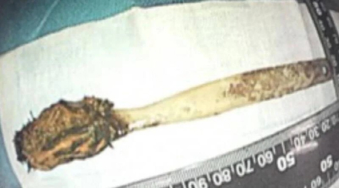 몸속에서 52년 전 삼킨 칫솔 발견…"분해될 줄 알았다"