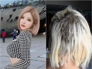 DJ소다 충격 탈모…