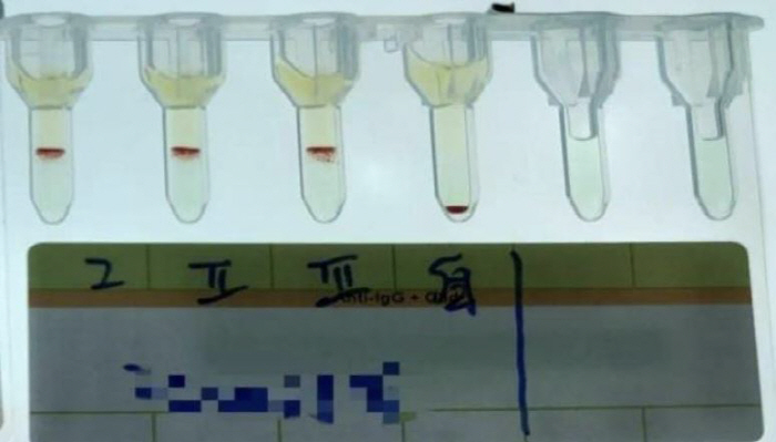 공룡 피보다 더 희귀한 '소P형' 혈액형 발견…100만명 중 1명 미만 …