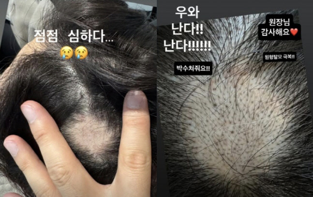 '이솔이♥' 박성광, '뻥' 뚫린 심각한 원형 탈모 극복 "미쳤다"