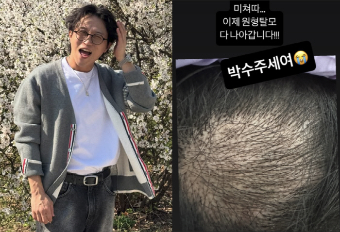 '이솔이♥' 박성광, '뻥' 뚫린 심각한 원형 탈모 극복 "미쳤다"