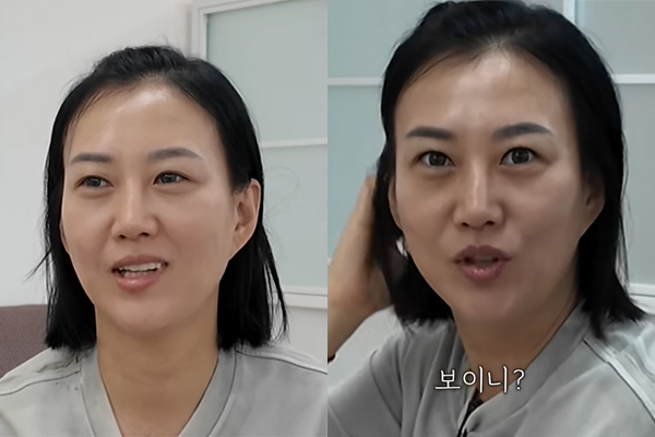 장윤정, 솔직 고백 “눈 시술 받았다”..더 커진 눈매