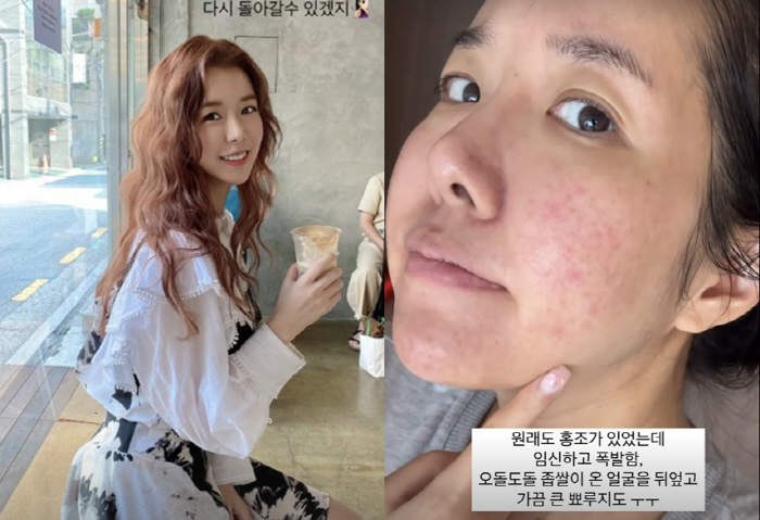 '쌍둥이 임신' 김지혜, 낙상사고 후 또 안타까운 근황 "홍조·좁쌀·뾰루…